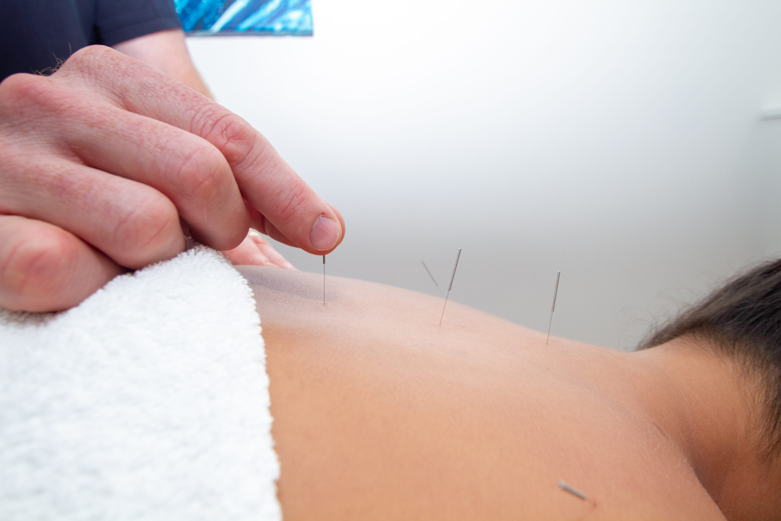 Practitioner Providing Acupuncture Treatment for Back Pain