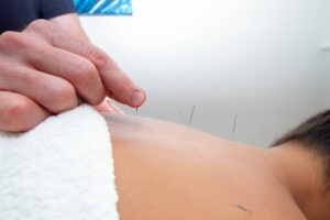 patient receiving acupuncture treatment to relieve back pain