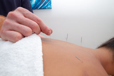 Acupuncture for pain relief