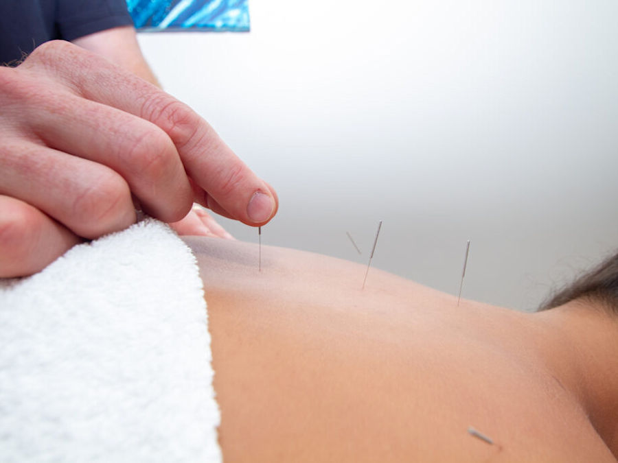 Acupuncturist treating back pain with Acupuncture