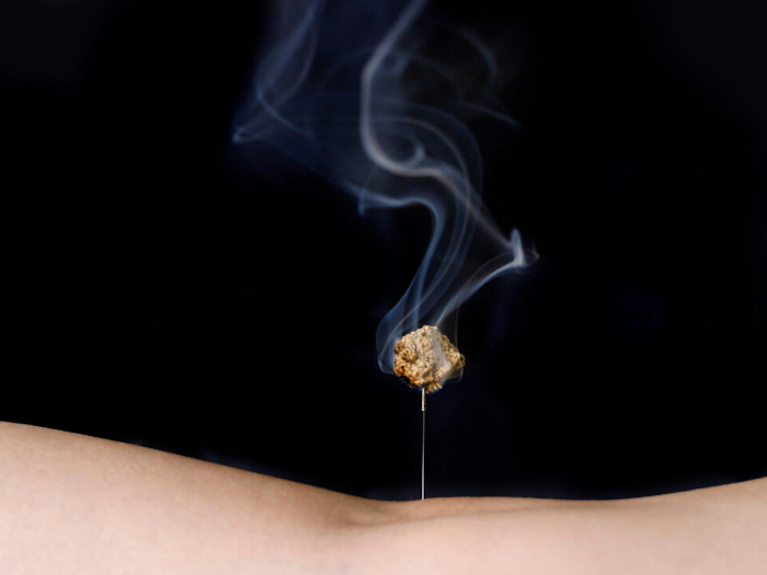 moxibustion applied on acupuncture needle