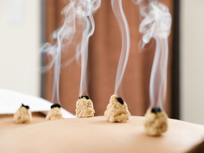 Moxibustion treatment on patients back 