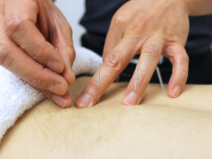 practitioner providing acupuncture treatment for back pain