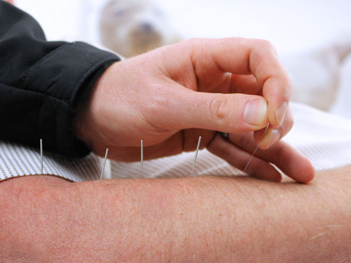 practitioner providing acupuncture for pain relief in the arm