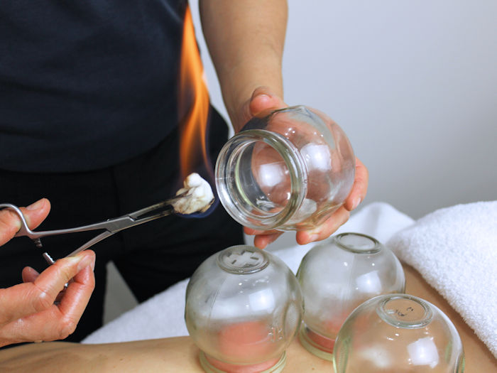 practitioner providing cupping therapy for lower back pain