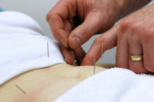 Woman receiving Acupuncture treatment for fertility support during IVF