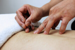 Acupuncture vs Dr Needling - Patient Receiving Acupuncture Treatment