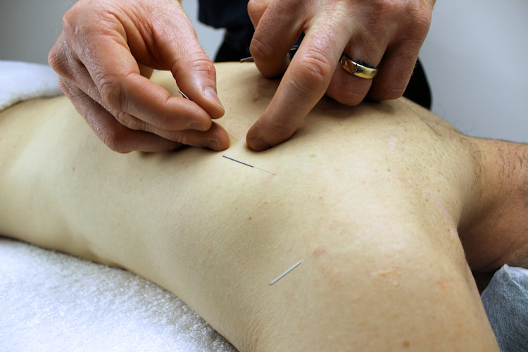 acupuncture for shoulder pain