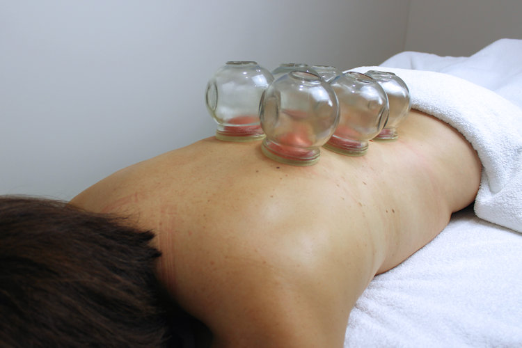 cupping for trigger point therapy