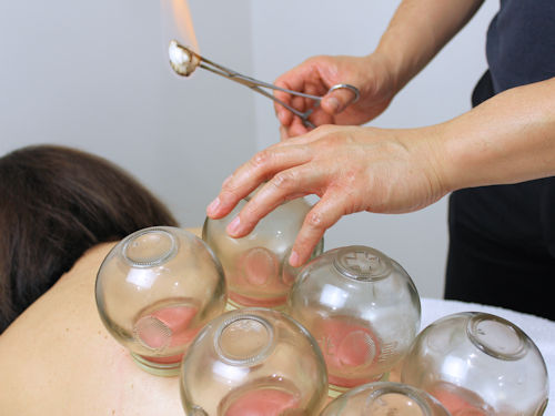 Practitioner providing cupping to relive back pain from bulging discs