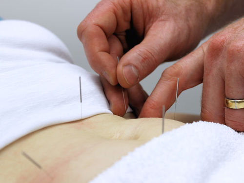 patient receiving acupuncture treatment to help improve IVF outcomes