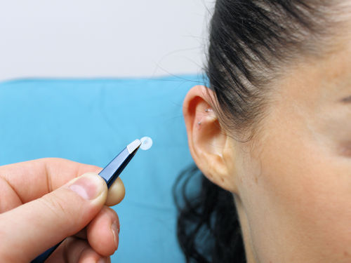 Patient receiving ear seeds auriculotherapy for pain relief