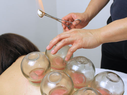 patient receiving cupping therapy to reduce stress and relax muscles