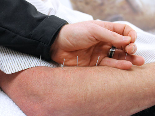 Practitioner providing acupuncture in arm for arthritis