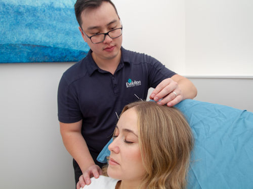 person receiving acupuncture treatment to relive sinus pain