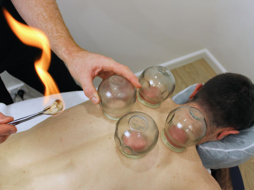 patient receiving cupping therapy for a solution to sinusitis and headache pain