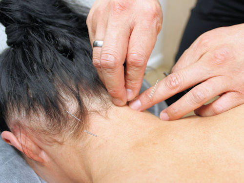 practitioner providing acupuncture treatment to provide headache relief
