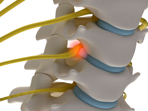 spine structure showing nerve pain and lower back pain