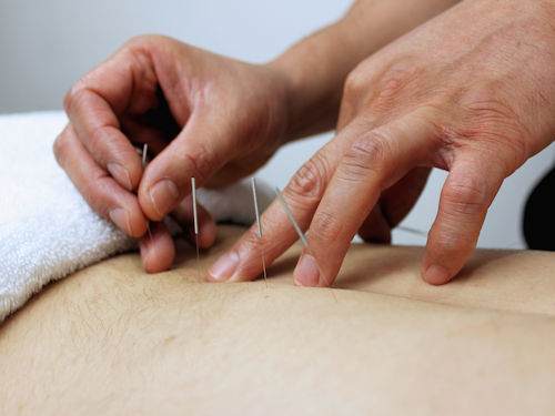 patient receiving acupuncture treatment to help with weight loss