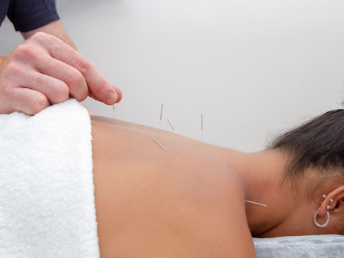 patient receiving acupuncture treatment to alleviate back pain