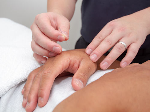 Patient dealing with insomnia receiving acupuncture treatment to help regulate sleep 