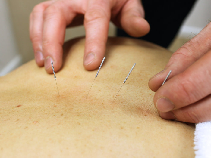 acupuncture treatment as a holistic approach to reduce back pain