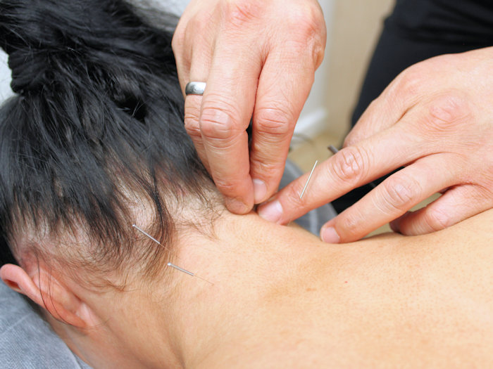 acupuncture treatment for natural solutions for neck pain