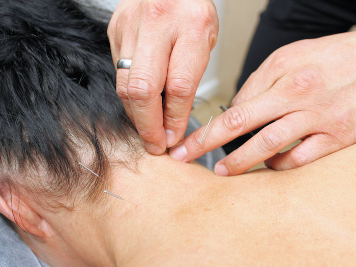 acupuncture treatment to prevent migraines