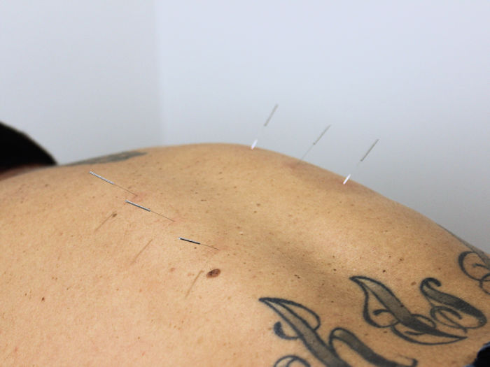 acupuncture treatment to reduce back pain naturally