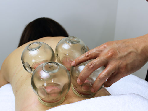 patient receiving cupping therapy to alleviate arthritis symptoms