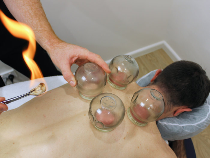 cupping therapy providing natural pain relief