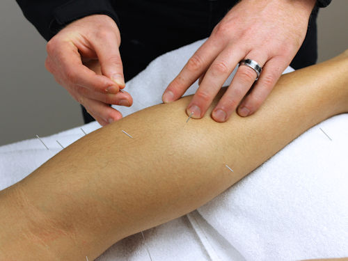 Acupuncture as a natural treatment for relief from fibromyalgia symptoms
