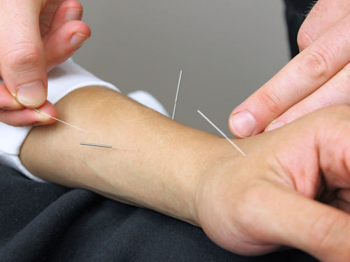 patient receiving acupuncture treatment to help relieve symptoms from panic attacks