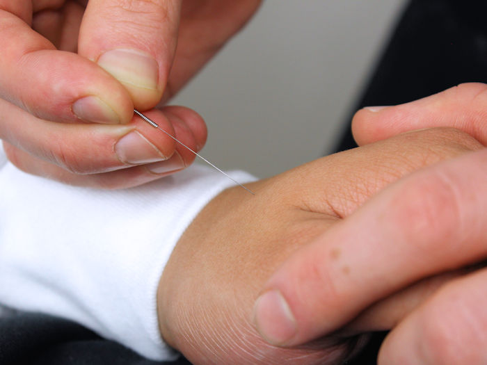 patient recieving acupuncture treatment to alleviate anxiety symptoms