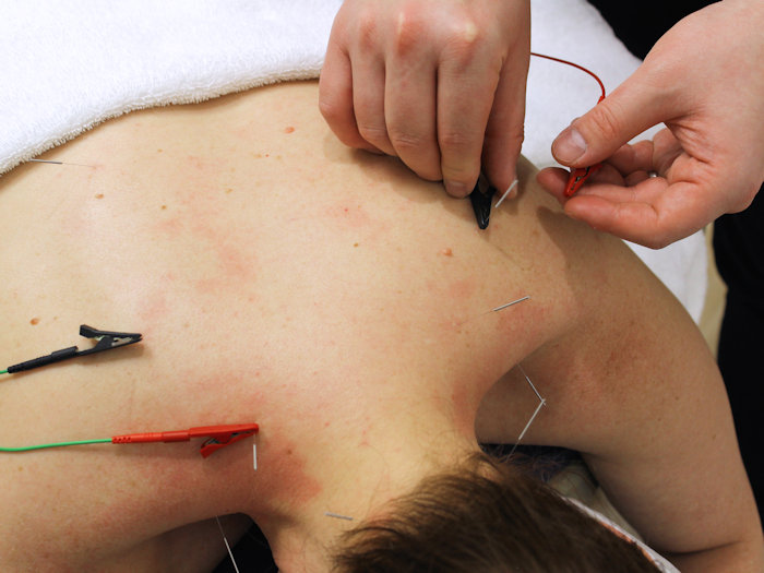 practitioner placing electro acupuncture on acupuncture needles
