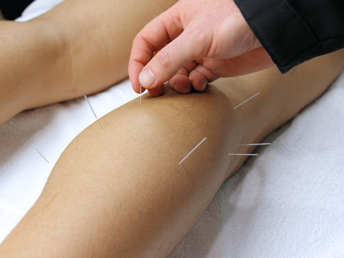 acupuncture treatment for heel pain