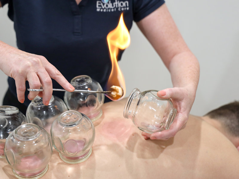 cupping therapy for removing toxins and stimulating the lymphatic system