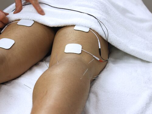 TENS therapy combined with Acupuncture for pain releif