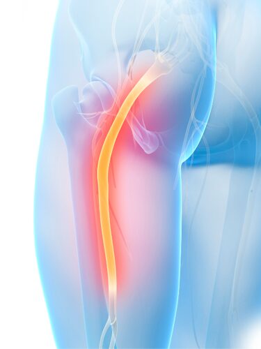 sciatic nerve pain as a cause of back pain