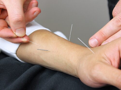 acupuncture as a natural treatment for carpal tunnel syndrome
