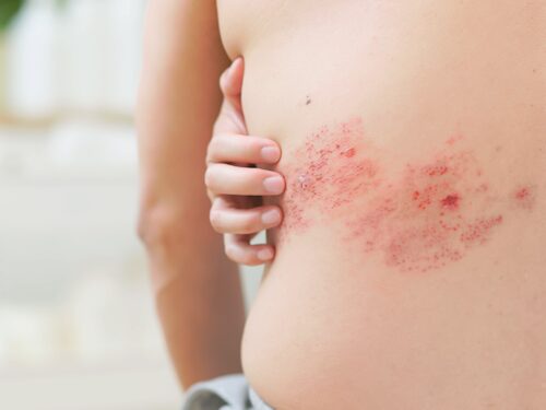 person experiencing shingles virus rash and blistering