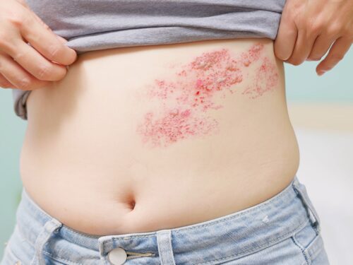 person with shingles virus experiencing pain and blisters