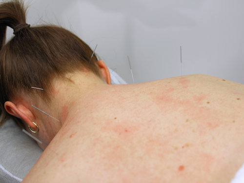 acupuncture used to promote recovery from frozen shoulder