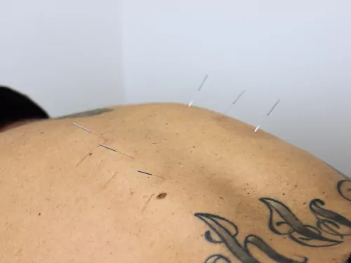 Acupuncture Needles