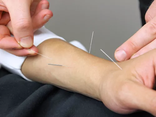 Acupuncture Needles