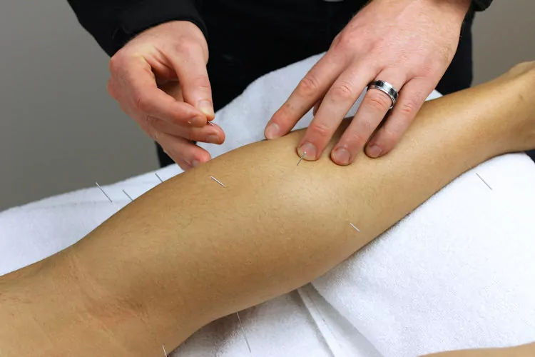 practitioner applying acupuncture for sciatica in leg