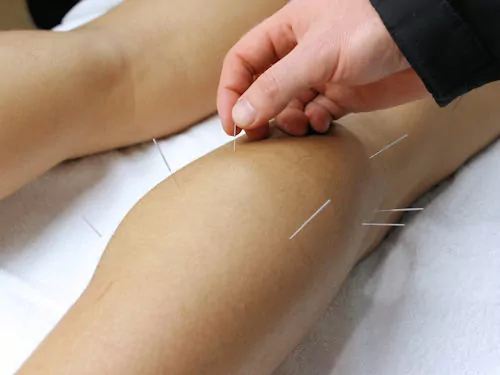 Patient receiving Acupuncture treatment 